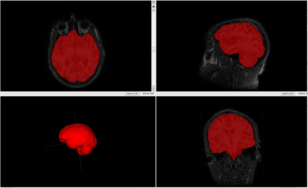 icv segmentation